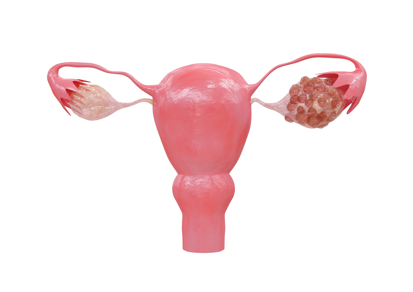 Eierstockzysten (Ovarialzysten): Ursachen, Symptome und Behandlung