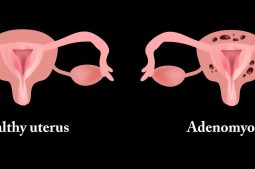 adenomyose schwangerschaft